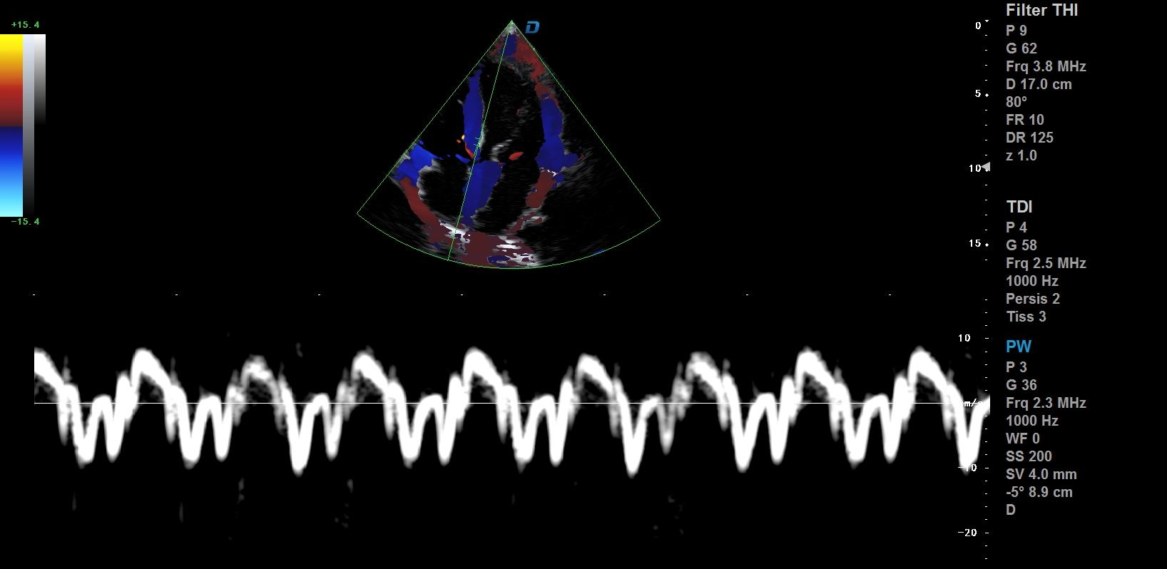 心臟彩超機和超聲心動圖的區別?